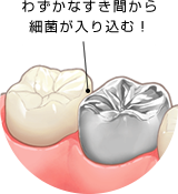 わずかなすき間から細菌が入り込む！