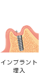 インプラント埋入