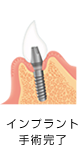 インプラント手術完了