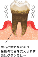 歯石と歯垢がたまり歯槽骨で歯を支えられず歯はグラグラに…