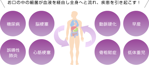 お口の中の細菌が血液を経由し全身へと流れ、疾患を引き起こす！ 糖尿病 脳梗塞 誤嚥性肺炎 心筋梗塞 動脈硬化 早産 骨粗鬆症 低体重児