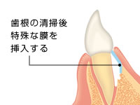 歯根の清掃後特殊な膜を挿入する