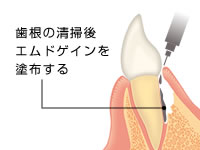 歯根の清掃後エムドゲインを塗布する