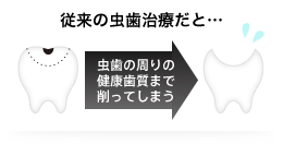 従来の虫歯治療だと…虫歯の周りの健康歯質まで削ってしまう